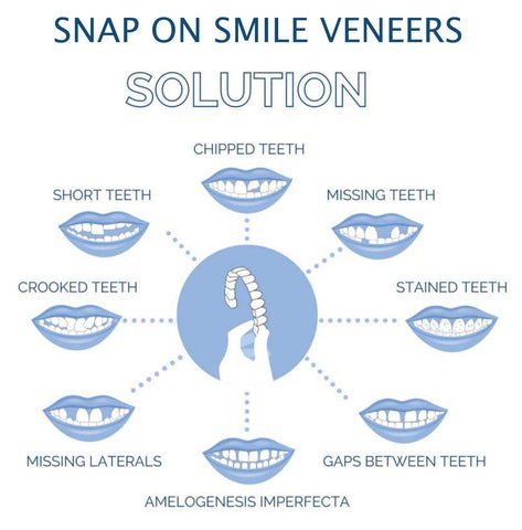 Clip-on Zahnveneers für sofortiges Lächeln oben & unten – Bild 6